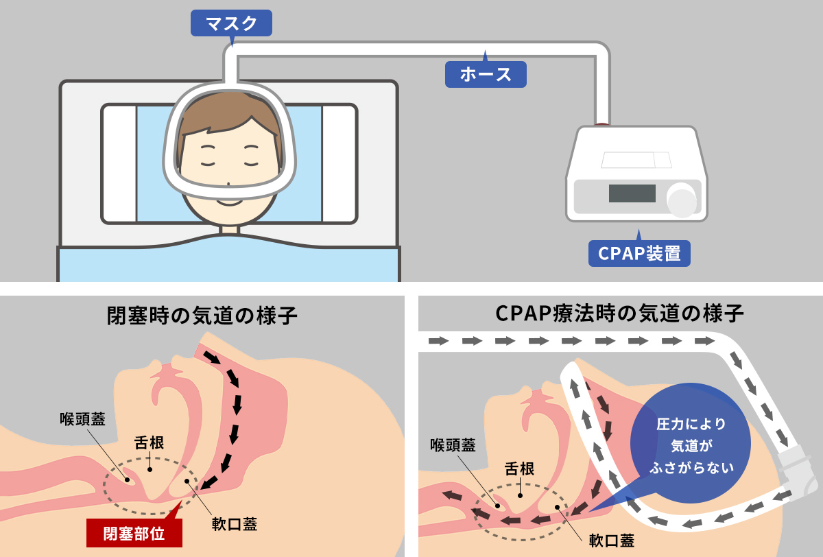 CPAP療法（持続陽圧呼吸療法）とは