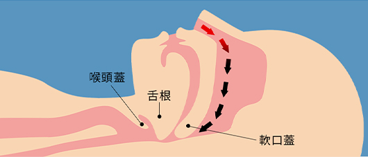 SAS患者さんの気道閉塞